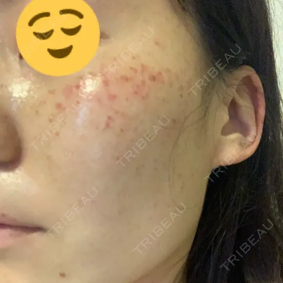 美肌レーザー / シミ取りレーザー たかはし形成外科･美容外科  AFTER メイン用