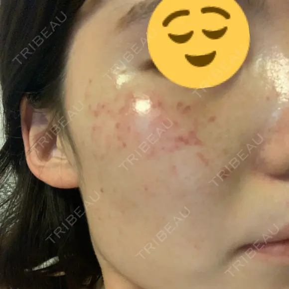 美肌レーザー / シミ取りレーザー たかはし形成外科･美容外科  DAY 44 メイン用