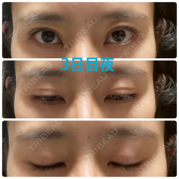 二重埋没 オジスキンクリニック AFTER メイン用