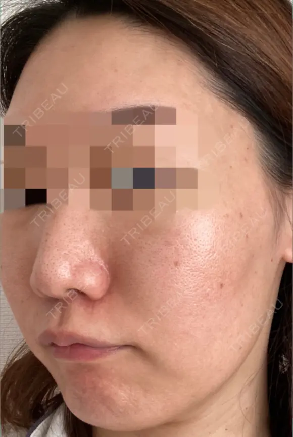 ダーマペン / 毛穴洗浄（ハイドラフェイシャルなど） AURORA CLINIC（オーロラクリニック）新宿院 DAY 8 メイン用