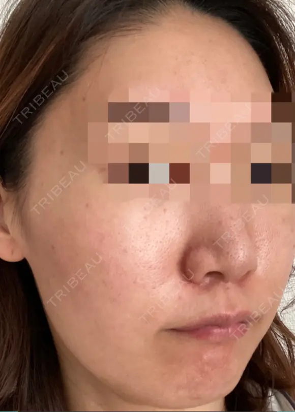 ダーマペン / 毛穴洗浄（ハイドラフェイシャルなど） AURORA CLINIC（オーロラクリニック）新宿院 AFTER メイン用