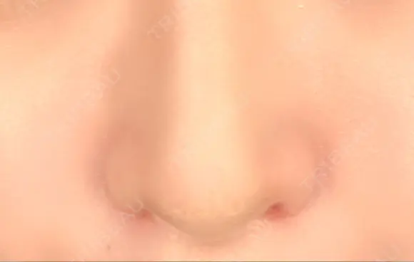 小鼻縮小（切開） / その他（鼻） みずほクリニック DAY 8 メイン用