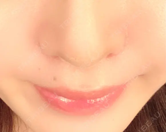 小鼻縮小（切開） / その他（鼻） みずほクリニック DAY 8 メイン用