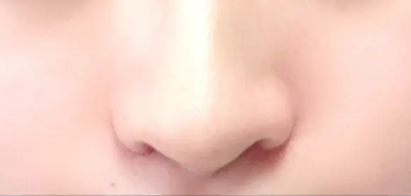 小鼻縮小（切開） / その他（鼻） みずほクリニック DAY 9 メイン用