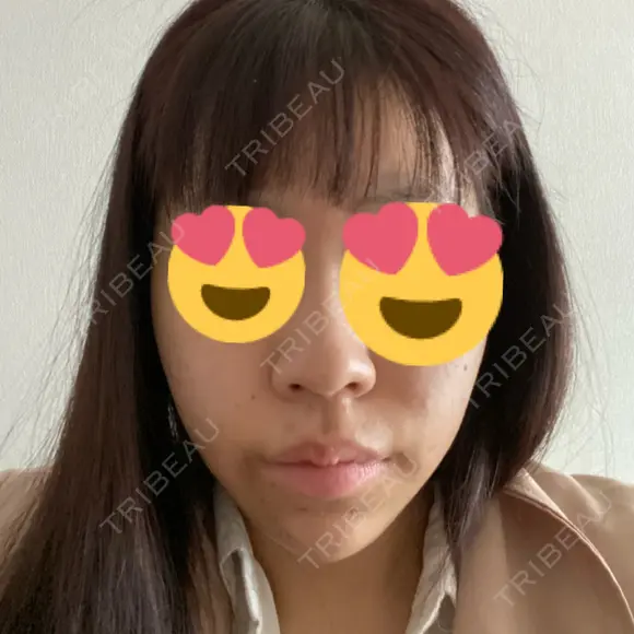 ヒアルロン酸注入（あご） TCB東京中央美容外科 池袋西口院 AFTER メイン用