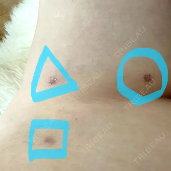 脂肪吸引（脚） / 豊胸（脂肪注入） 石倉クリニック 水戸院 DAY 22 メイン用