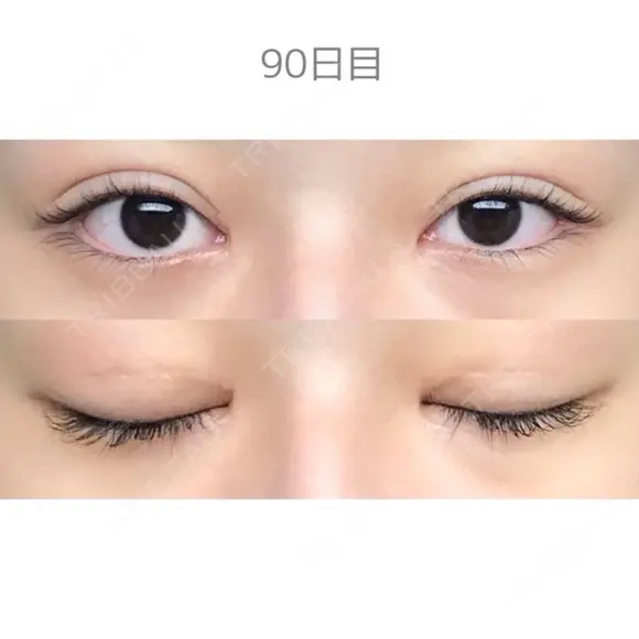 二重切開 / 目頭切開 / 上まぶたたるみ取り サラ美容外科 DAY 90 メイン用