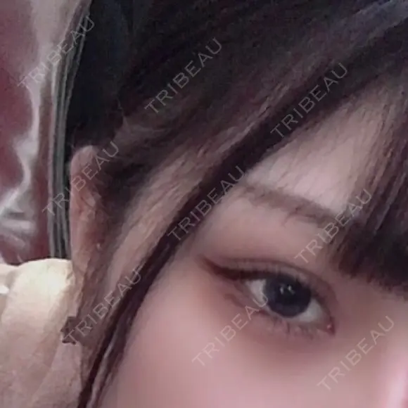二重切開 / 目頭切開 / 上まぶたたるみ取り サラ美容外科 DAY 90 メイン用