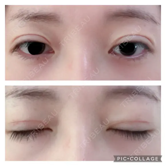 二重切開 松下皮フ形成外科 DAY 17 メイン用