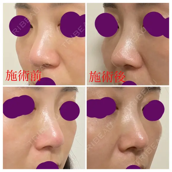 軟骨移植 フェアクリニック川口 DAY 30 メイン用
