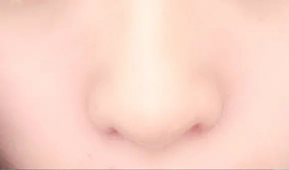 小鼻縮小（切開） / その他（鼻） みずほクリニック DAY 11 メイン用