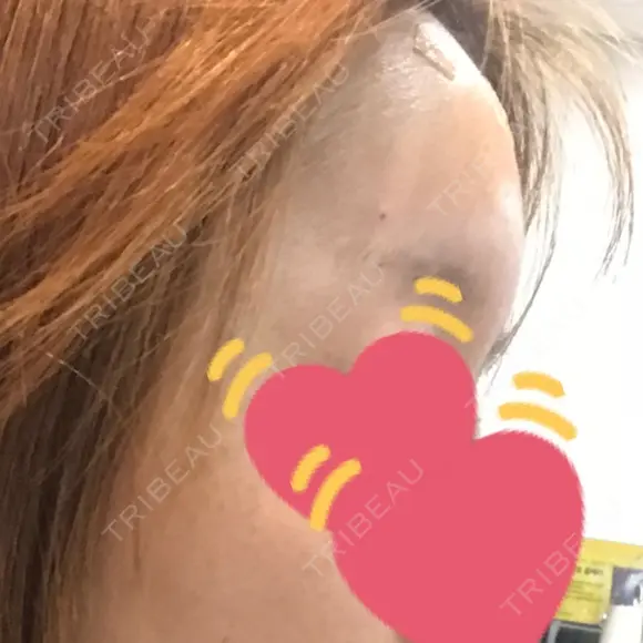 額を丸く ニューセンス皮膚科クリニック DAY 4 メイン用