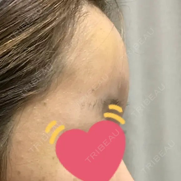 額を丸く ニューセンス皮膚科クリニック DAY 11 メイン用