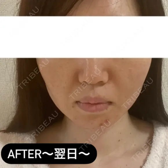 糸リフト / ヒアルロン酸注入（頬） EMMA CLINIC（エマクリニック） DAY 1 メイン用