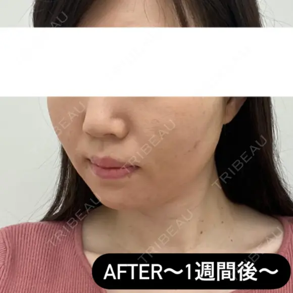 糸リフト / ヒアルロン酸注入（頬） EMMA CLINIC（エマクリニック） DAY 7 メイン用