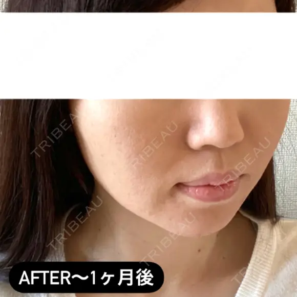 糸リフト / ヒアルロン酸注入（頬） EMMA CLINIC（エマクリニック） DAY 33 メイン用