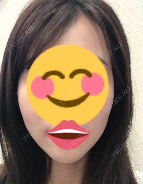 脂肪注入（輪郭） 湘南美容クリニック 新潟院 AFTER メイン用