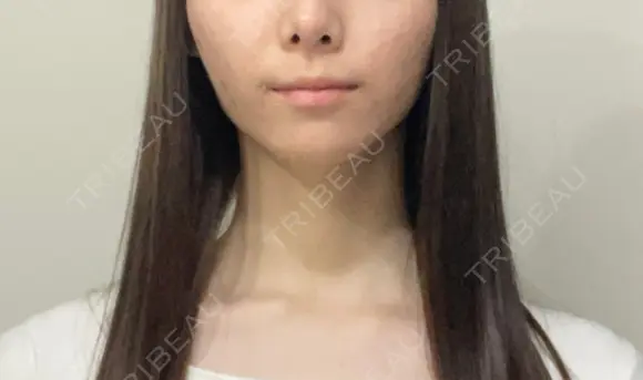 脂肪吸引（顔） Mods Clinic（モッズクリニック） 東京院 AFTER メイン用