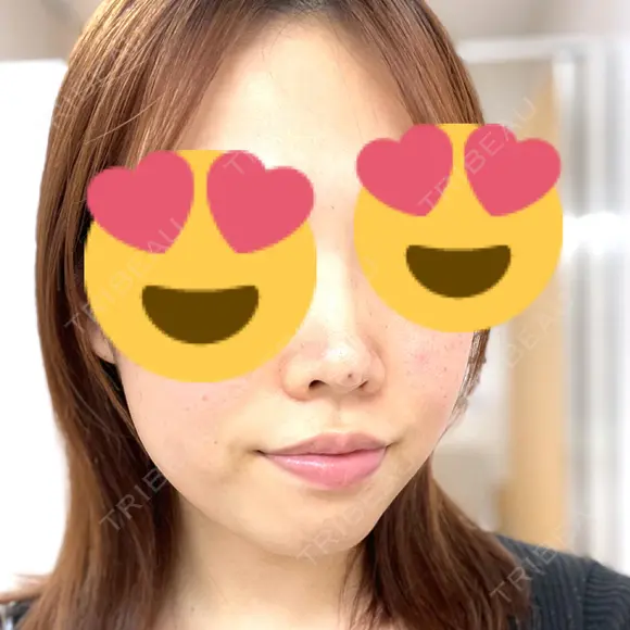 スレッドノーズ シンシアガーデンクリニック 太田院 DAY 0 メイン用