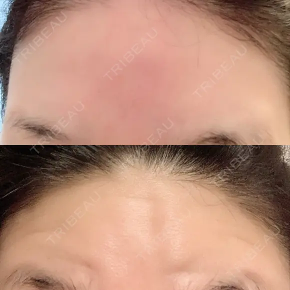 額を丸く / シワ取りボトックス / その他（肌） / その他（輪郭） 湘南美容クリニック 藤沢院 DAY 6 メイン用