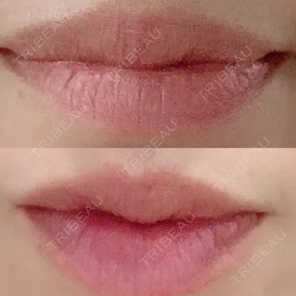 シワ取りボトックス 湘南美容クリニック 藤沢院 DAY 6 メイン用