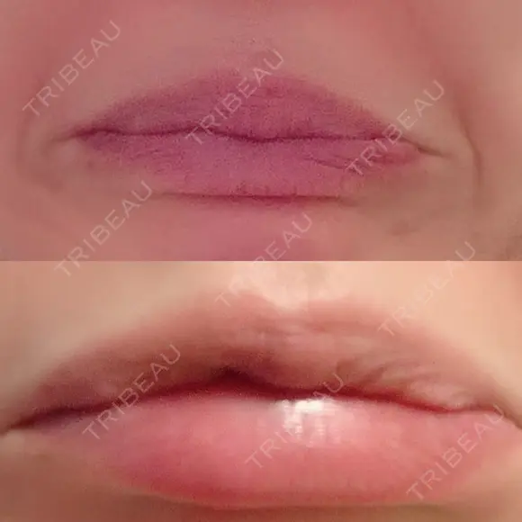 シワ取りボトックス 湘南美容クリニック 藤沢院 DAY 6 メイン用