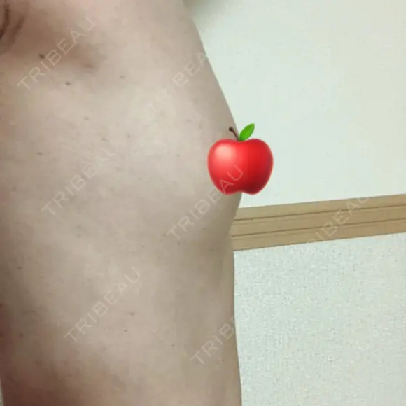 豊胸（脂肪注入） ヴェルトラクリニック 大阪院 DAY 212 メイン用