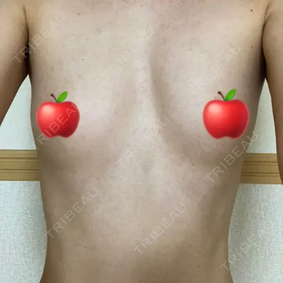 豊胸（脂肪注入） ヴェルトラクリニック 大阪院 DAY 212 メイン用