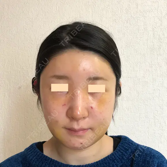 額を丸く / 脂肪注入（額） / 脂肪注入（輪郭） eクリニック 金沢本院 DAY 5 メイン用