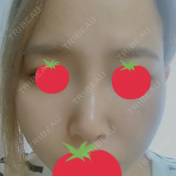 隆鼻術 / 鼻中隔延長（切開） / 軟骨移植 / 鼻尖縮小 しらさぎ形成クリニック 徳島院 DAY 31 メイン用