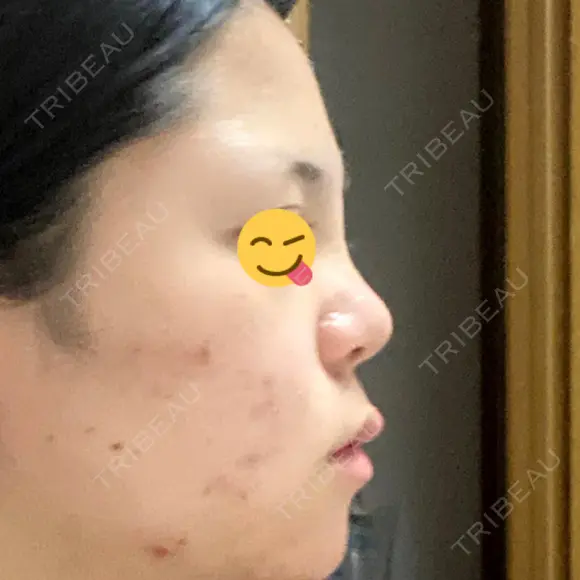 隆鼻術 湘南美容クリニック 姫路院 DAY 3 メイン用