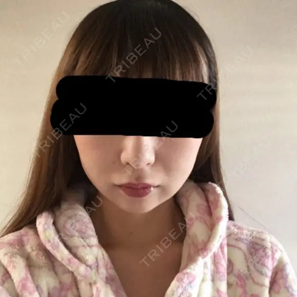 脂肪吸引（顔） / その他（輪郭） / 脂肪注入（輪郭） ヴィヴェンシアクリニック DAY 27 メイン用