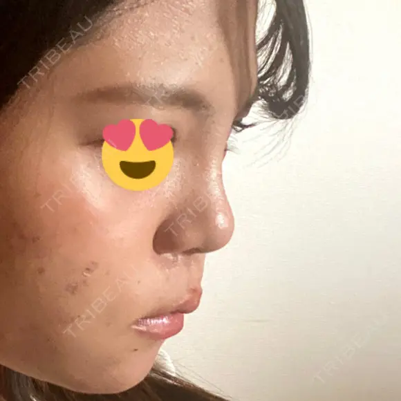 隆鼻術 湘南美容クリニック 姫路院 DAY 7 メイン用