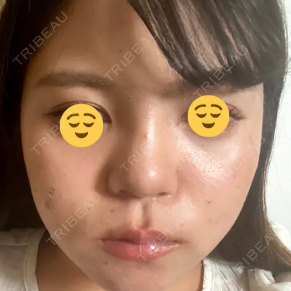 隆鼻術 湘南美容クリニック 姫路院 DAY 7 メイン用