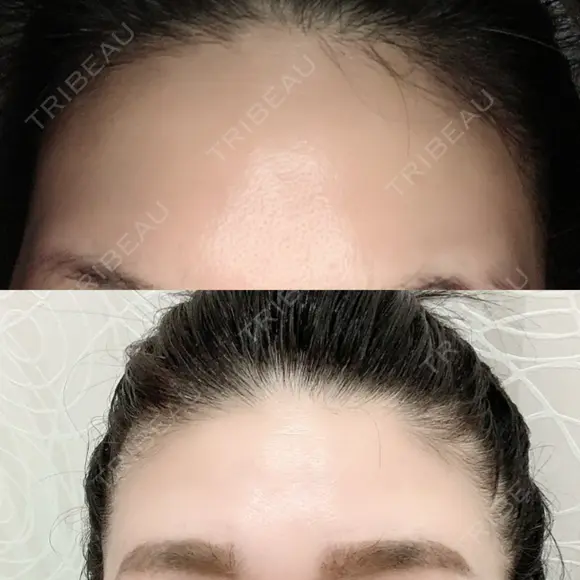 額を丸く / シワ取りボトックス / その他（肌） / その他（輪郭） 湘南美容クリニック 藤沢院 DAY 9 メイン用