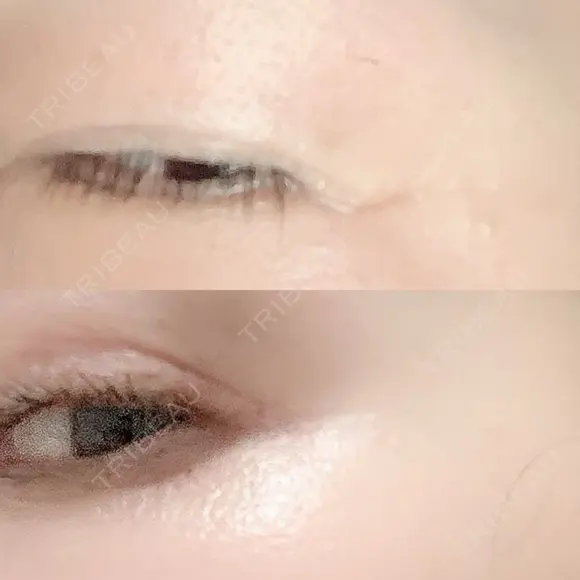 シワ取りボトックス 湘南美容クリニック 藤沢院 DAY 9 メイン用