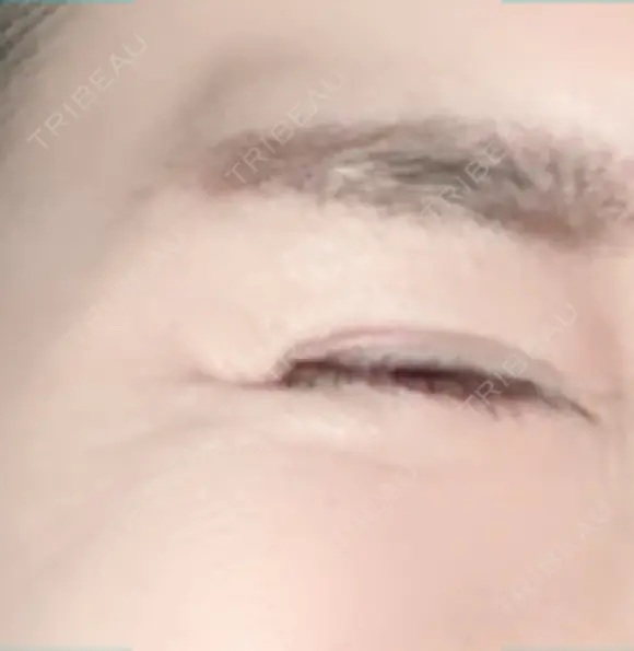 シワ取りボトックス 湘南美容クリニック 藤沢院 DAY 9 メイン用