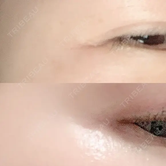 シワ取りボトックス 湘南美容クリニック 藤沢院 DAY 9 メイン用