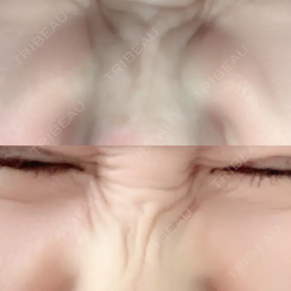 シワ取りボトックス 湘南美容クリニック 藤沢院 DAY 9 メイン用