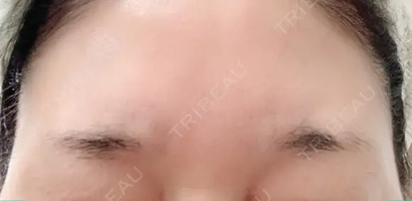 シワ取りボトックス 湘南美容クリニック 藤沢院 DAY 9 メイン用