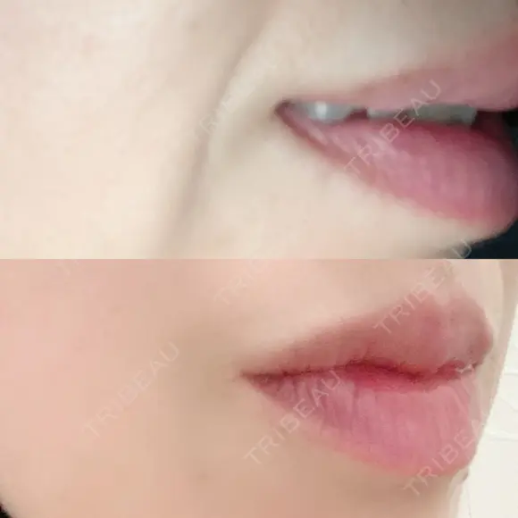 シワ取りボトックス 湘南美容クリニック 藤沢院 DAY 9 メイン用