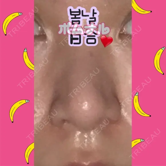 鼻尖形成（切開） / 小鼻縮小（切開） / 軟骨移植 / 鼻孔縁挙上 / 鼻尖縮小 ヴェリテクリニック 大阪院 DAY 28 メイン用