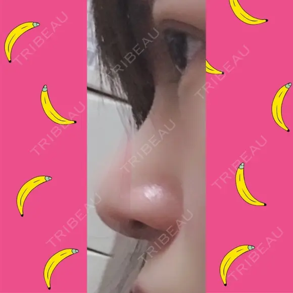 鼻尖形成（切開） / 小鼻縮小（切開） / 軟骨移植 / 鼻孔縁挙上 / 鼻尖縮小 ヴェリテクリニック 大阪院 DAY 28 メイン用