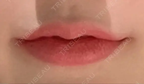 口唇縮小術 / 口角挙上 B-LINE CLINIC 池袋院 AFTER メイン用