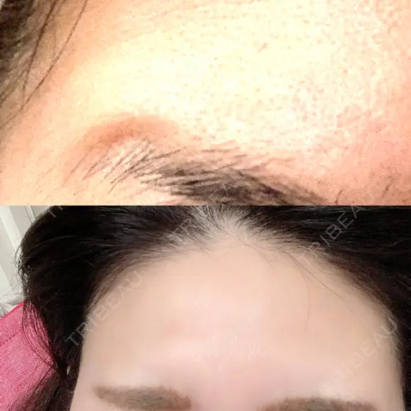 額を丸く / シワ取りボトックス / その他（肌） / その他（輪郭） 湘南美容クリニック 藤沢院 DAY 10 メイン用