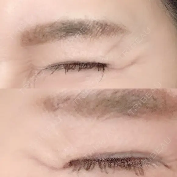 シワ取りボトックス 湘南美容クリニック 藤沢院 DAY 12 メイン用