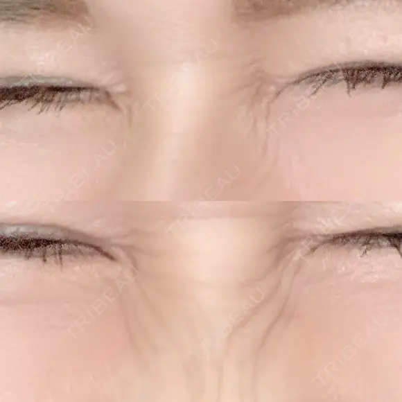 シワ取りボトックス 湘南美容クリニック 藤沢院 DAY 12 メイン用