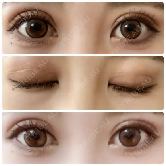 二重切開 / 上まぶたたるみ取り 城本クリニック 姫路院 DAY 41 メイン用