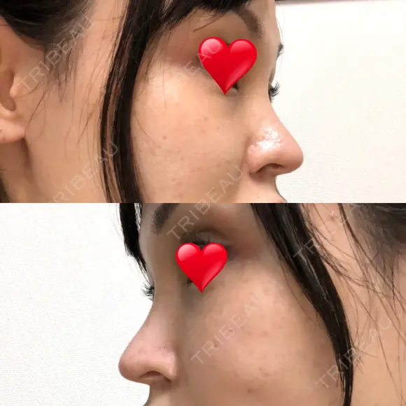 隆鼻術 / 鼻尖形成（切開） / 鼻中隔延長（切開） / 軟骨移植 / プロテーゼ除去 / 鼻修正 THE ROPPONGI CLINIC（ザ 六本木クリニック） DAY 78 メイン用