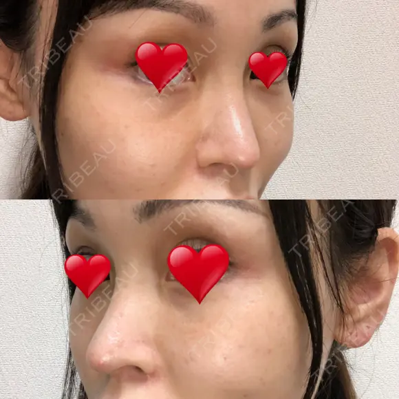 隆鼻術 / 鼻尖形成（切開） / 鼻中隔延長（切開） / 軟骨移植 / プロテーゼ除去 / 鼻修正 THE ROPPONGI CLINIC（ザ 六本木クリニック） DAY 78 メイン用